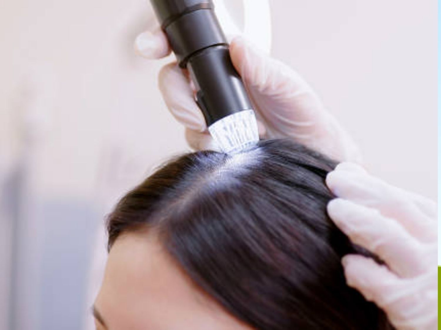 bác sĩ soi da đầu để chẩn đoán tình trạng tóc rụng từng mảng do nguyên nhân nào gây ra