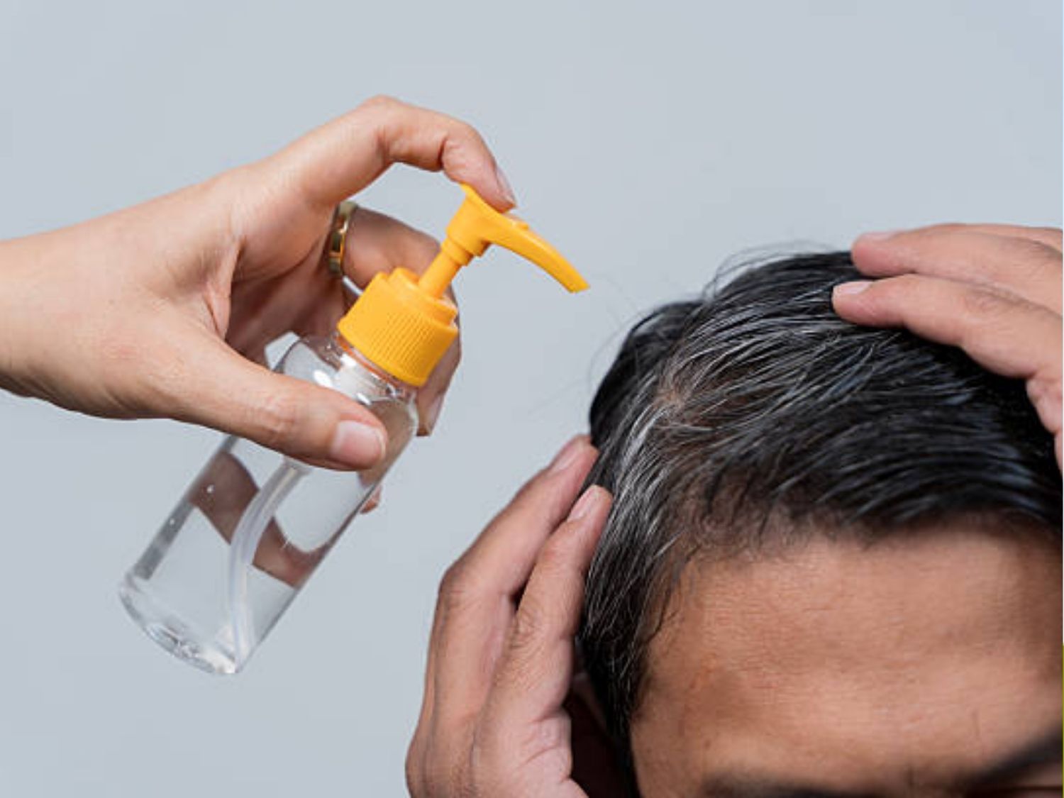 sử dụng thuốc chống viêm tại chỗ tóc rụng theo mảng để kích thích tóc mọc lại