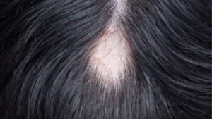 Trị rụng tóc từng mảng: 5 Phương pháp điều trị và cách giúp tóc mọc lại