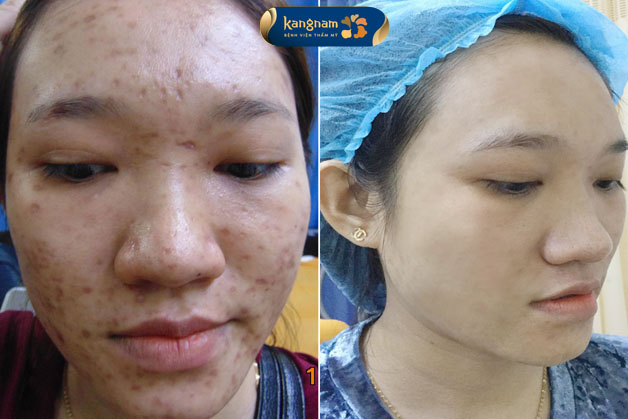 ảnh trước và sau khi trị sẹo rỗ của khách hàng, da mịn màng và láng hơn sau 1 liệu trình
