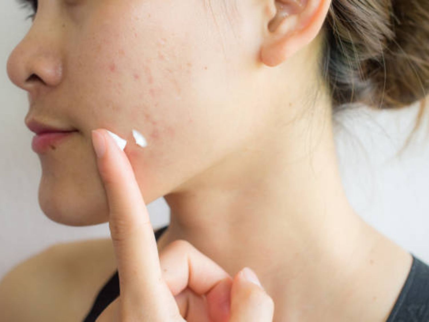Sản phẩm bôi ngoài da cải thiện tình trạng da sau mụn