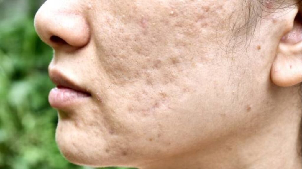 Trị sẹo mụn: 7 phương pháp cải thiện sẹo hiệu quả