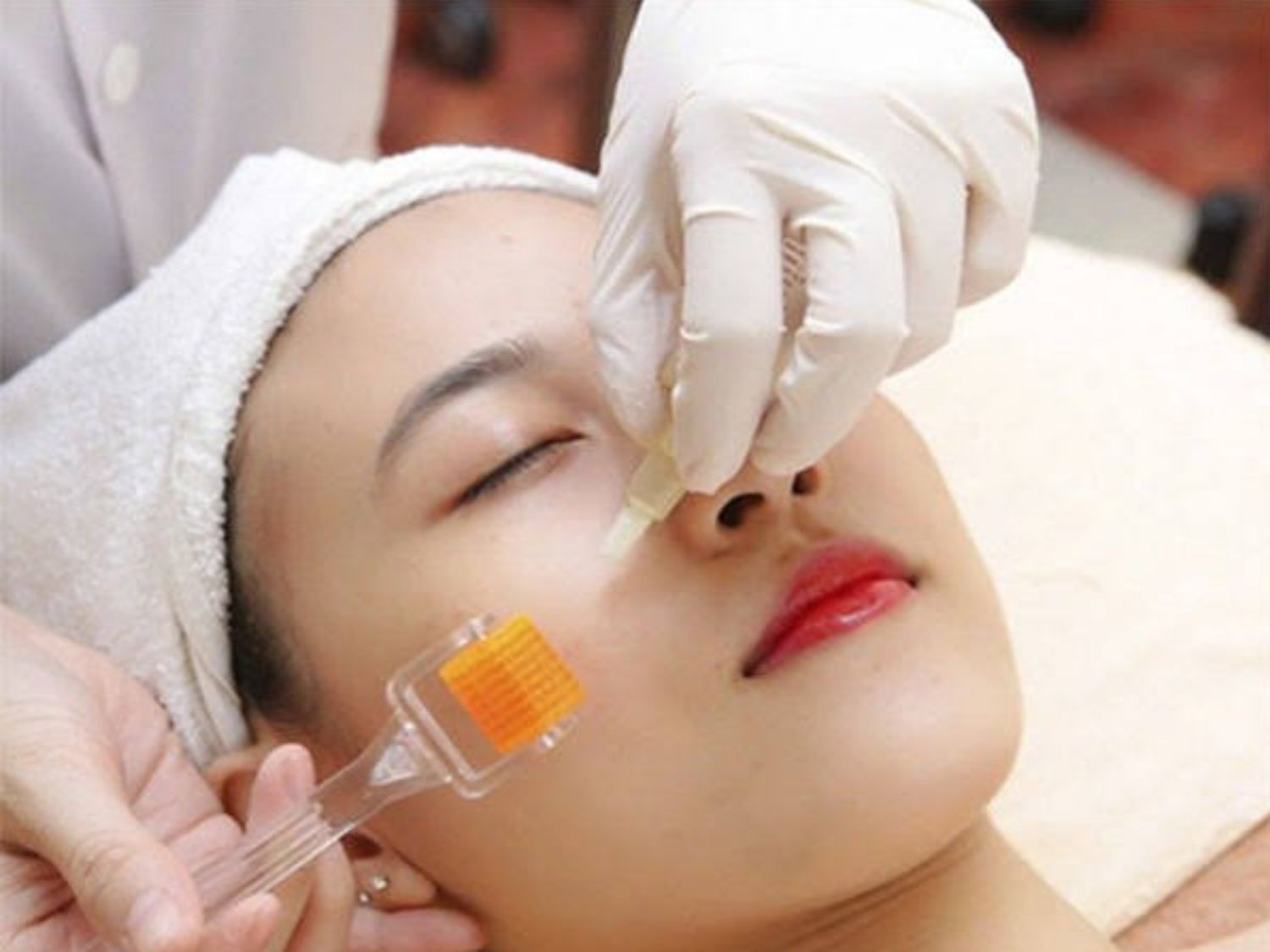 vi kim tạo ra những vi tổn thương có kiểm soát trên bề mặt da để làm lành sẹo