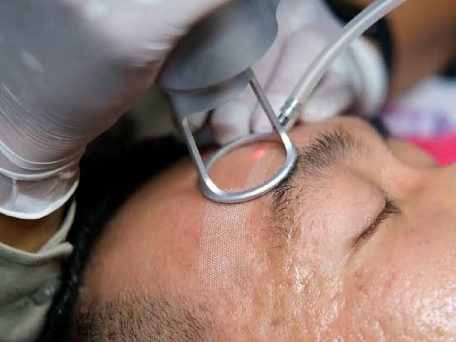 Laser tái tạo bề mặt tạo ra các vùng tác động có kiểm soát trên da