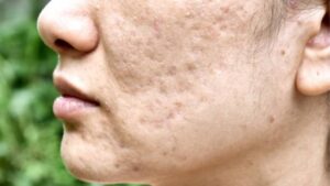 Trị sẹo mụn: 7 phương pháp cải thiện sẹo hiệu quả