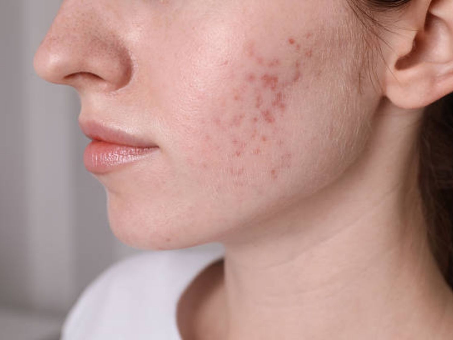 Sẹo mụn là những thay đổi ở cấu trúc da