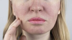 Trị sẹo rỗ: Nguyên nhân, phân loại và các phương pháp điều trị hiệu quả