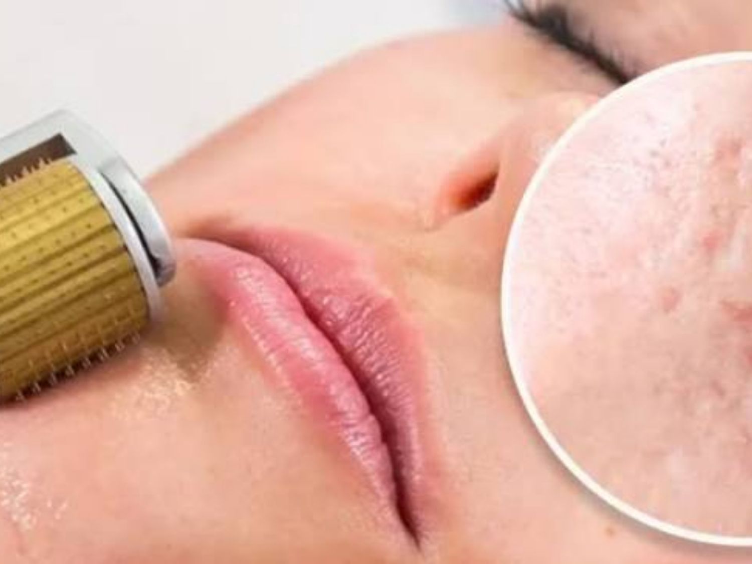 Tạo vi tổn thương bằng kim điều trị sẹo rỗ