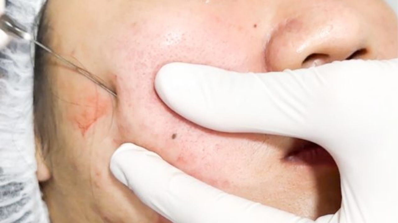 Bóc tách đáy sẹo là thủ thuật xâm lấn tối thiểu , bề mặt da bị kéo ghì xuống sẽ được giải phóng hoàn toàn