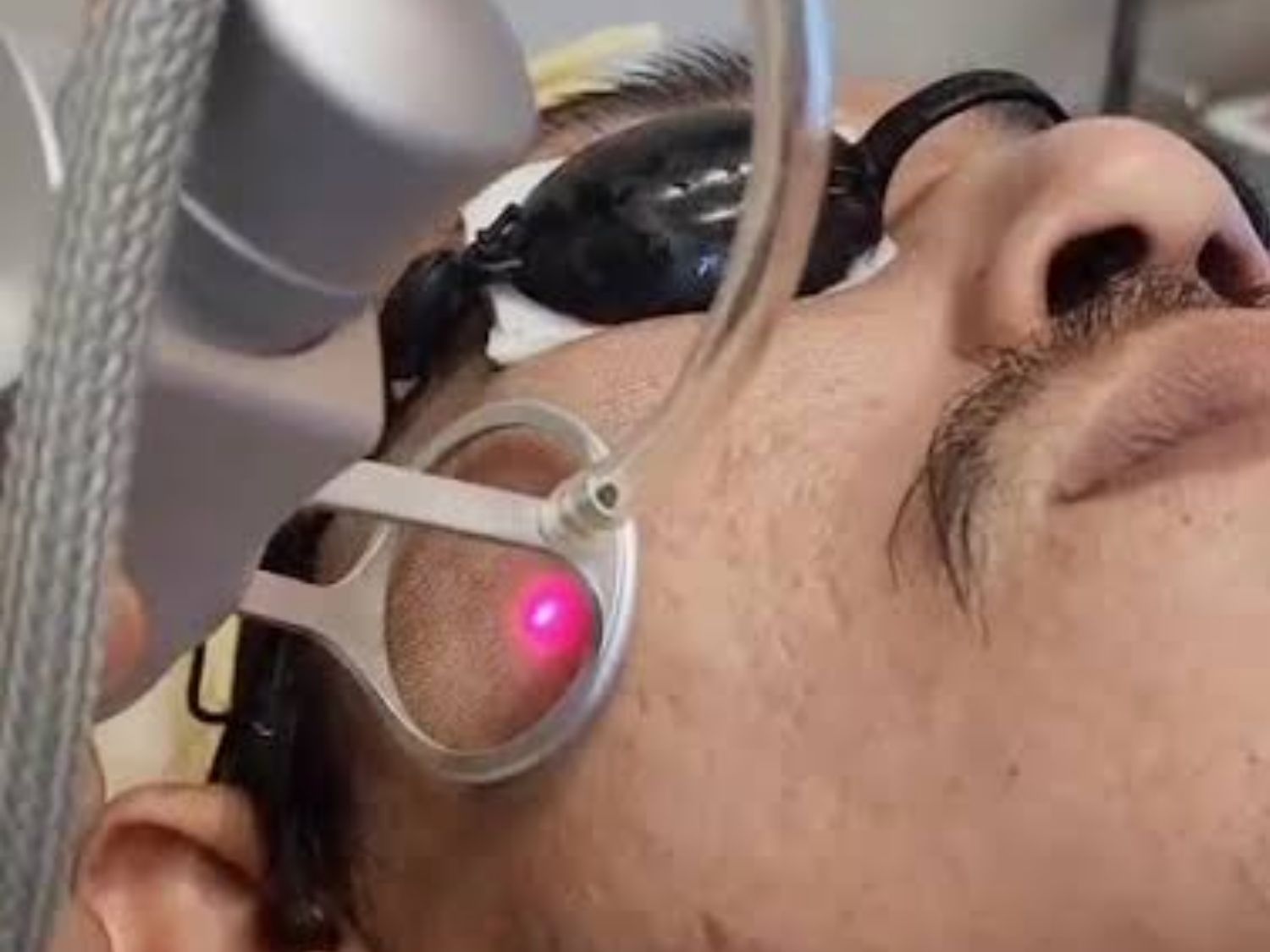 Laser CO₂ vi điểm thúc đẩy quá trình phục hồi