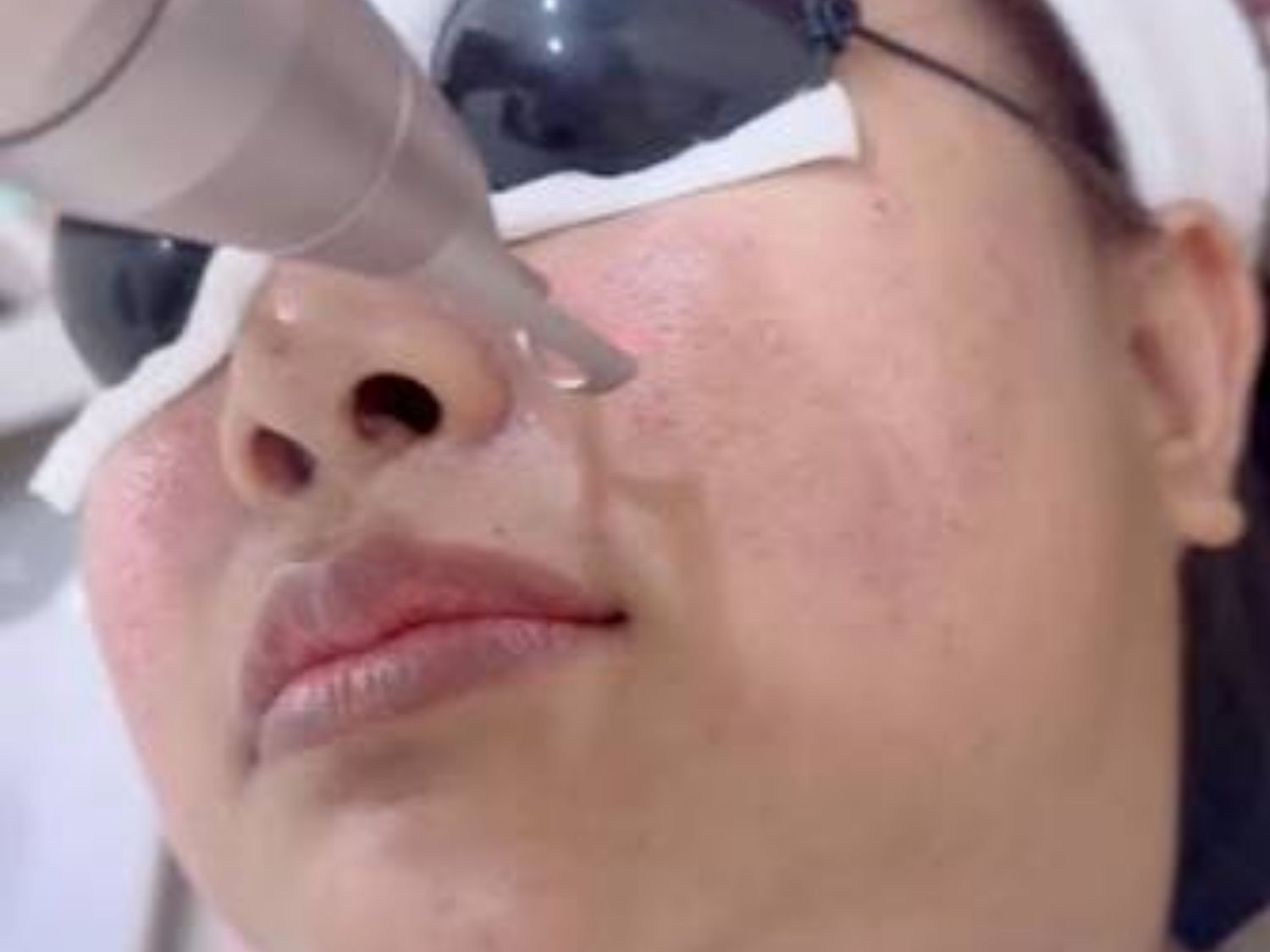 Laser PicoSure Pro truyền năng lượng trong khoảng thời gian cực ngắn vào da