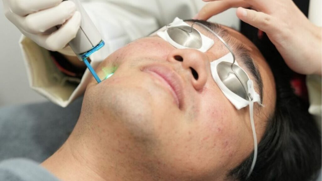 Trị sẹo rỗ bằng laser: Hiệu quả, quy trình, chi phí và cách chăm sóc