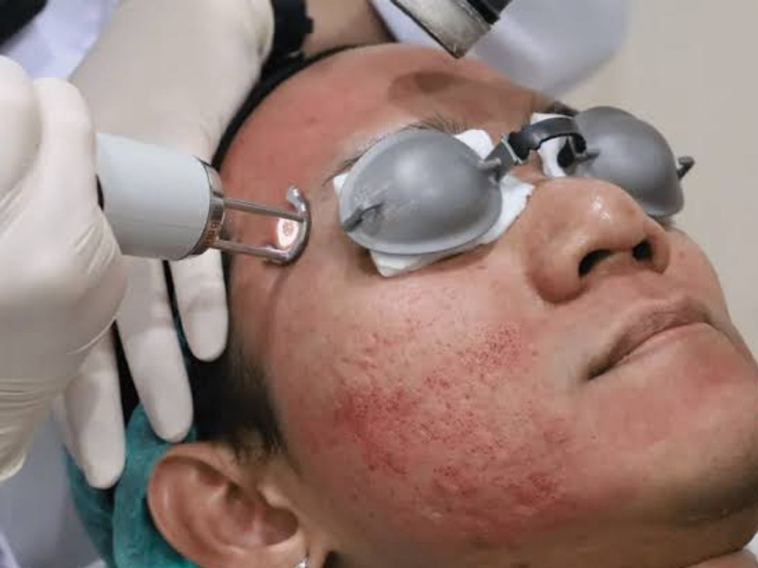 Laser có thể cải thiện đáng kể sẹo rỗ, bác sĩ áp dụng laser cho tình trạng sẹo rỗ nặng
