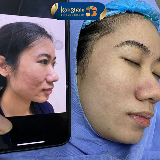 sẹo mụn lâu năm cải thiện đáng kể sau 1 liệu trình