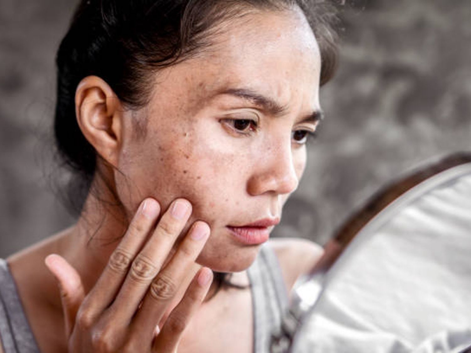 Đốm nâu tăng kích thước nhanh, ảnh hưởng đến tinh thần, ngoại hình