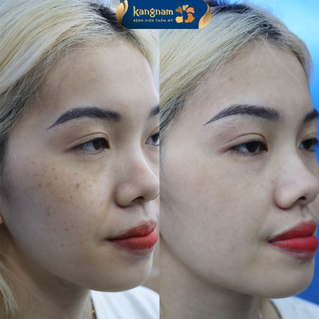 ảnh khách hàng trị tàn nhang tại Kangnam. sau liệu trình da sáng khỏe