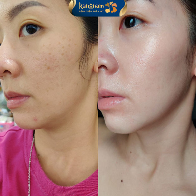 khách hàng cải thiện rõ tàn nhang sau 1 liệu trình điều trị tại Kangnam