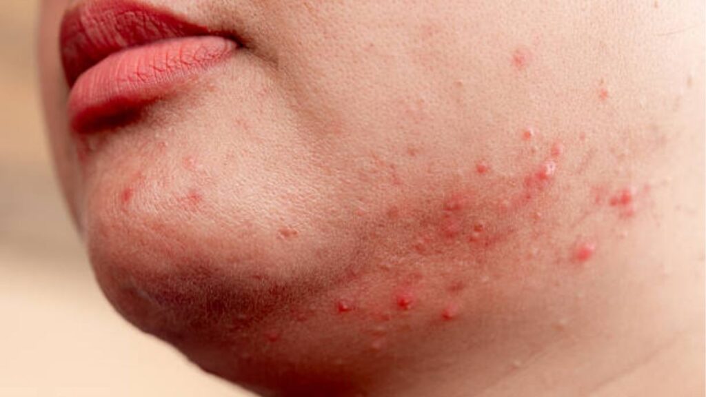 Trị mụn viêm đỏ hiệu quả: Phác đồ theo từng mức độ mụn