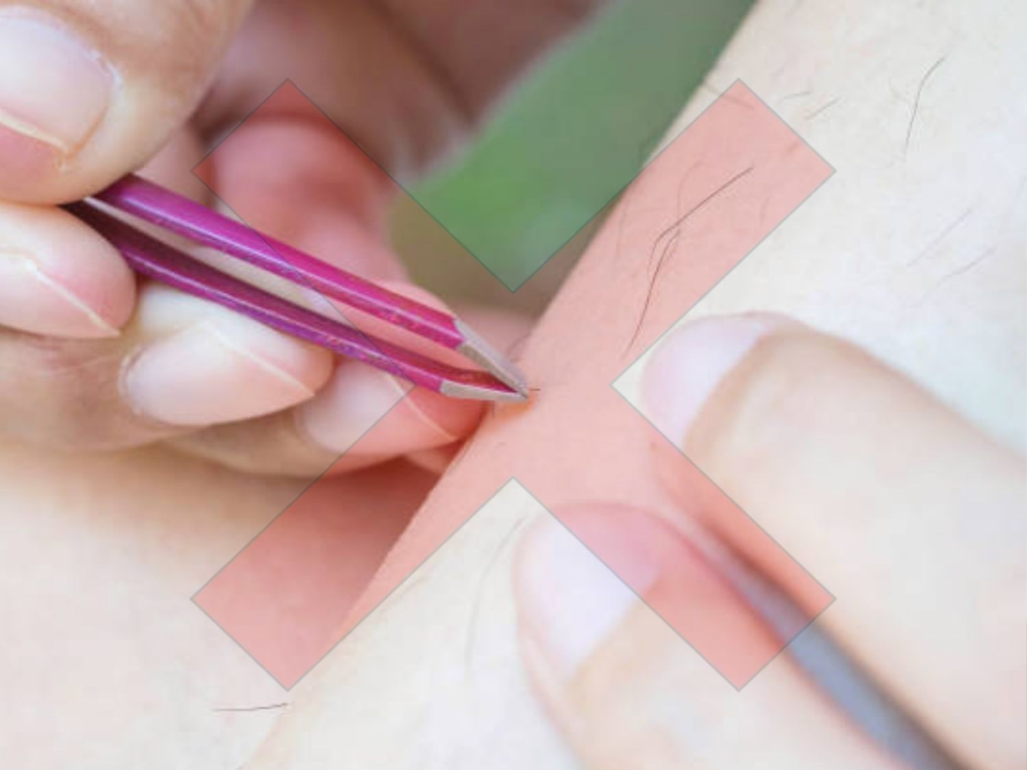 không nhổ lông chân sau khi đã triệt lông bằng laser để tránh làm tổn thương da