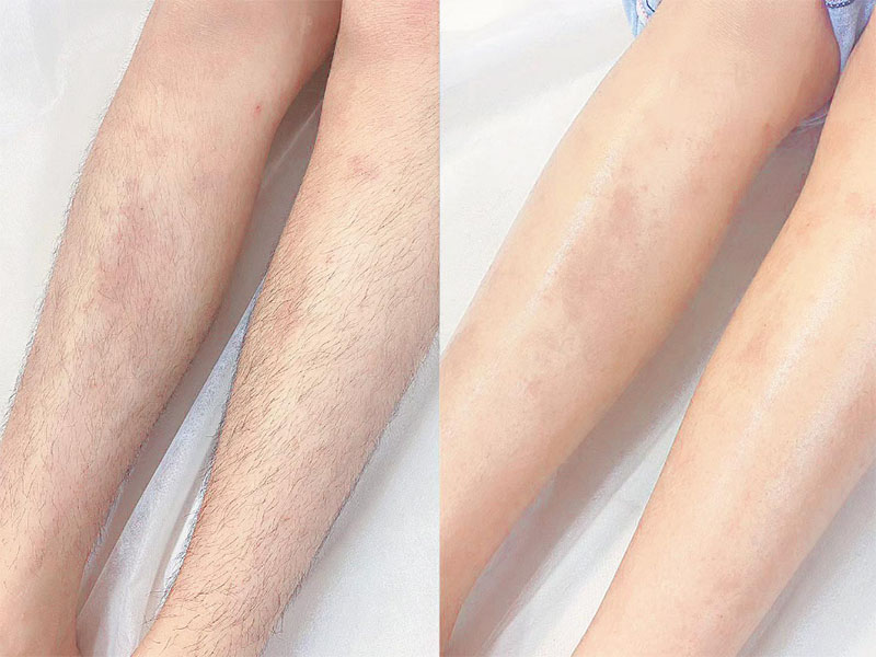 Triệt sạch lông chân sau 1 liệu trình, lông sau mọc lại tơ mảnh và khó thấy