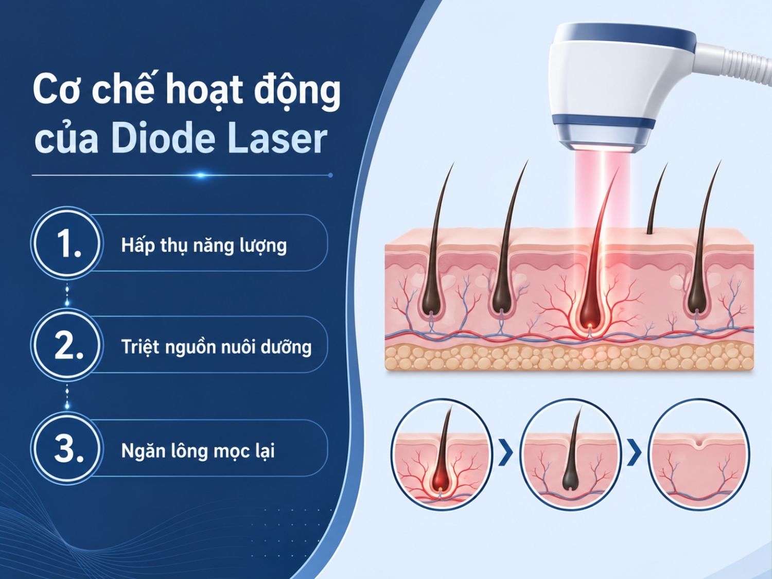 ảnh mô tả Cơ chế hoạt động của Diode Laser