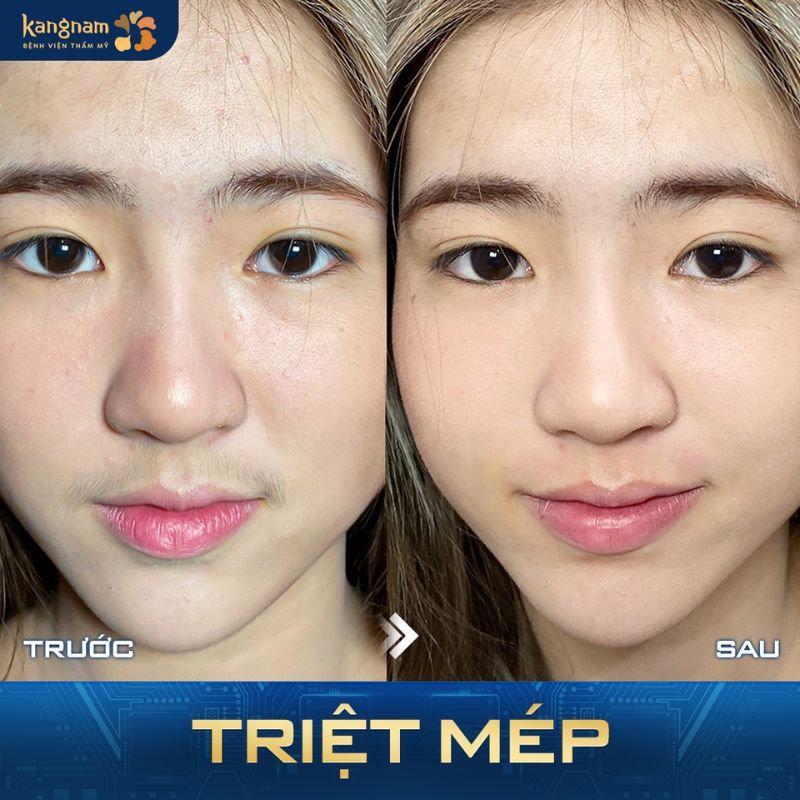ảnh trước sau của khách hàng triệt ria mép tại Kangnam. Mặt sáng hơn, nữ tính hơn
