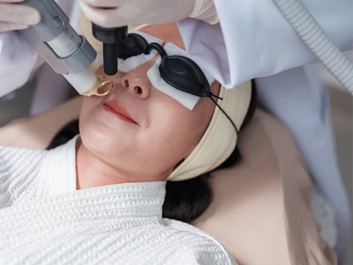 Triệt lông mép bằng Laser nhanh chóng, an toàn và nhẹ nhàng, lông mọc lại thưa và mỏng