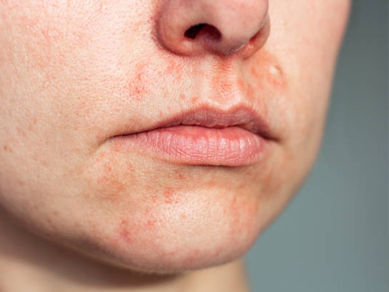 da đang có mụn viêm không nên triệt lông mép vì dễ khiến mụn viêm lan rộng