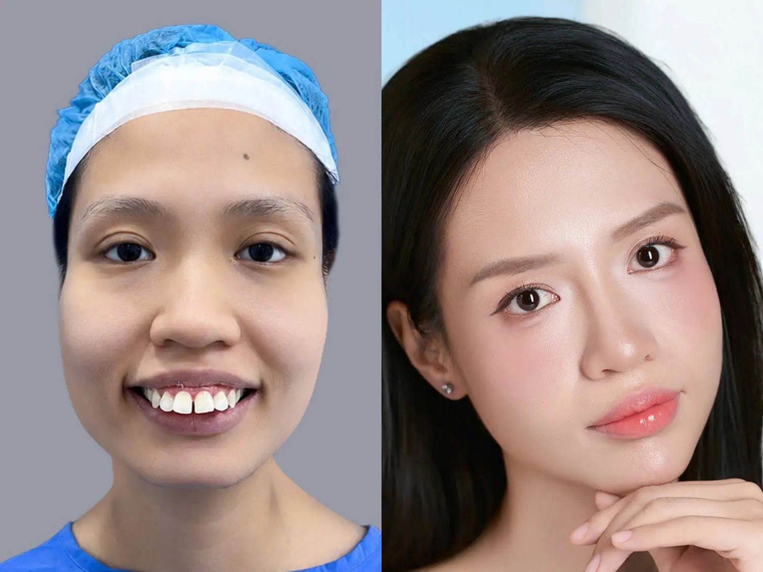Vũ Thị Tình trước và sau khi chỉnh hàm hô, nhan sắc vịt hóa thiên nga