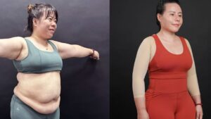 Béo có hút mỡ được không? 85kg có cần giảm cân trước hay không