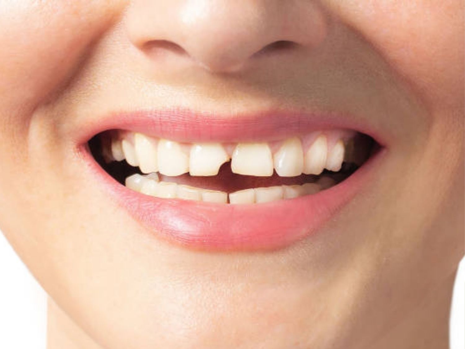 Răng sứ nứt mẻ do sử dụng loại răng không chất lượng