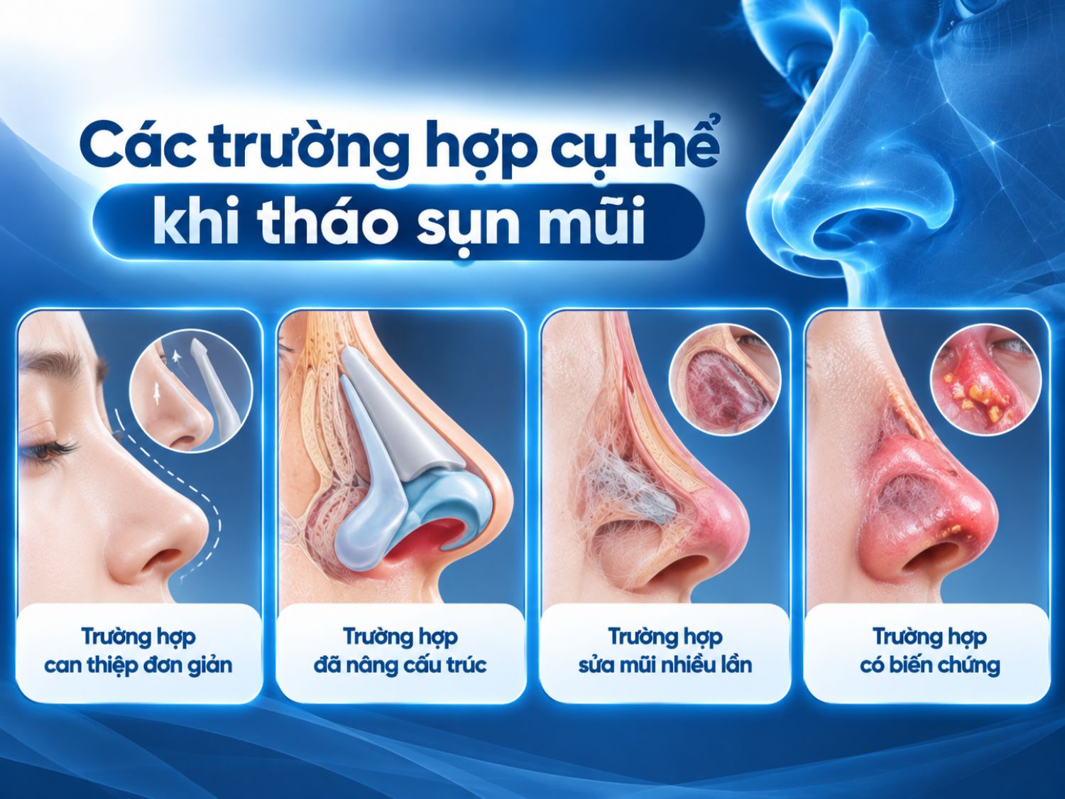 Tháo sụn mũi cần được đánh giá theo tình trạng cụ thể, đặc biệt khi mũi đã nâng cấu trúc, sửa nhiều lần hoặc xuất hiện biến chứng.