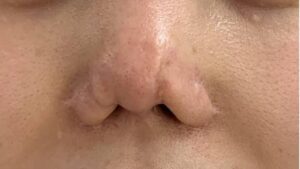Chi phí sửa mũi hỏng khoảng bao nhiêu?