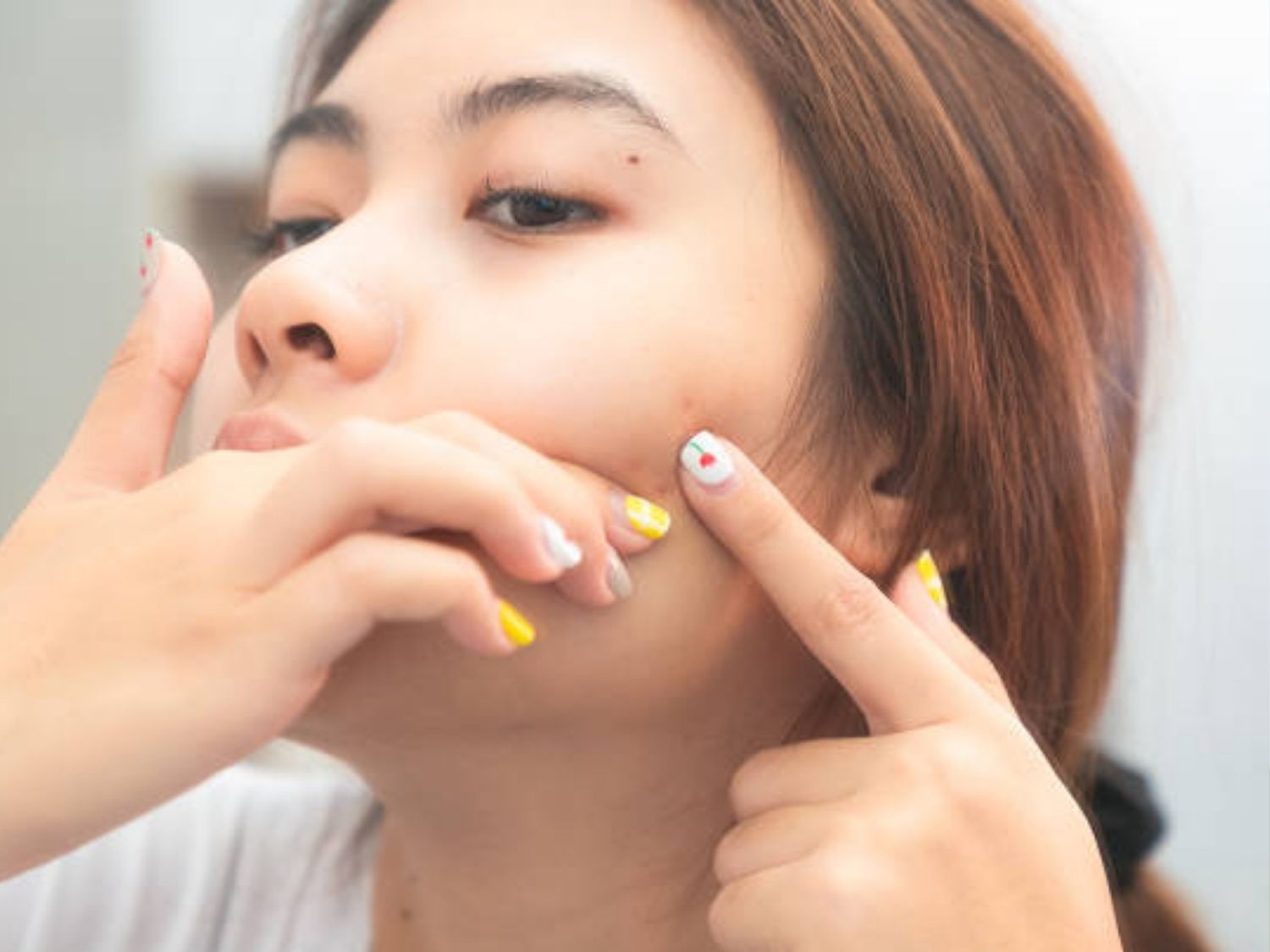 Không nên tự ý cạy vảy hay nặn mụn trên da
