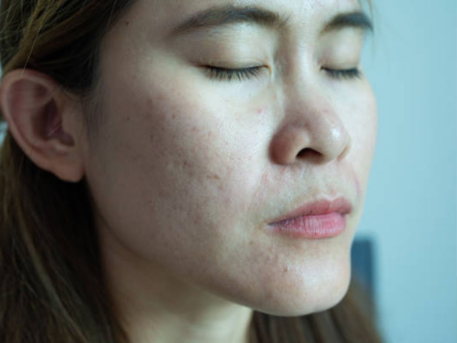 Da mỏng và lộ mao mạch khi bị tổn thương
