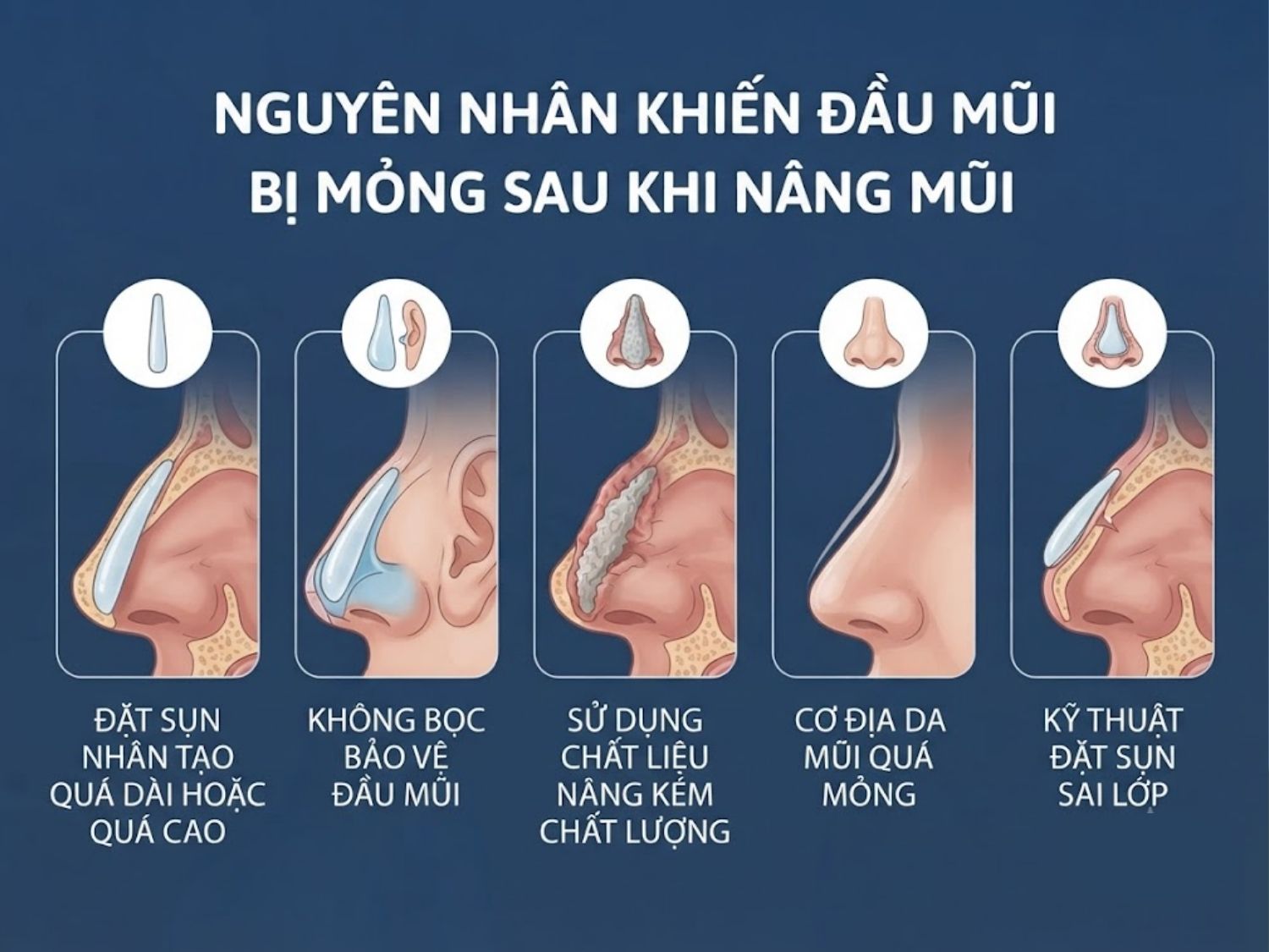 đặt sụn nhân tạo quá dài hoặc quá cao, thiếu công đoạn bọc bảo vệ đầu mũi, dùng chất liệu nâng kém chất lượng là nguyên nhân đầu mũi bóng đỏ