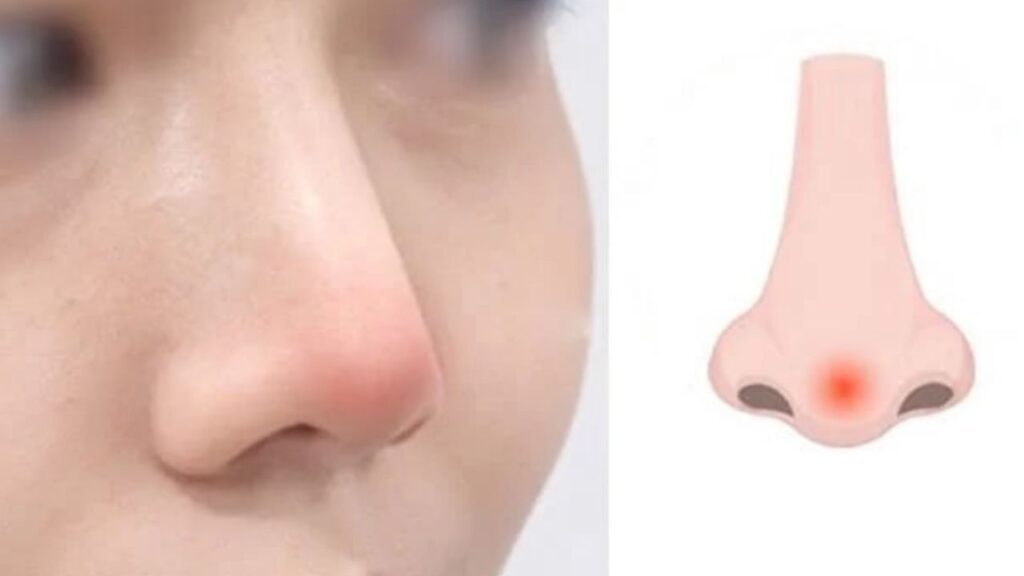 Đầu mũi bị mỏng và sắp thủng thì phải làm gì ngay?