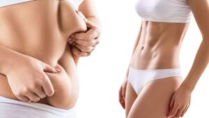 Hút mỡ ở bệnh viện công giá bao nhiêu? So với bệnh viện thẩm mỹ thì chênh nhiều không, vì sao lại chênh?