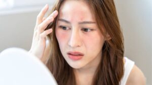 HIFU/RF bị hỏng và cách xử lý: bỏng, hõm má, tê, tái chảy xệ