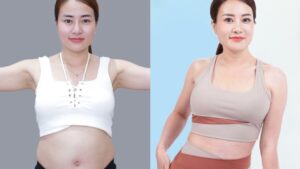 Hút mỡ khi nào thấy dáng? Mốc thời gian để vóc dáng vào form tự nhiên