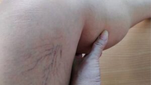 Hút mỡ có gây cục máu đông không? Nguy cơ, dấu hiệu và cách phòng tránh