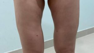 Hút mỡ đùi lồi lõm: Nguyên nhân, cách xử lý và thời gian ổn định