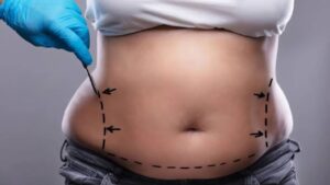 Hút mỡ giá rẻ có an toàn không? Chi phí hút mỡ chính xác gồm những gì?