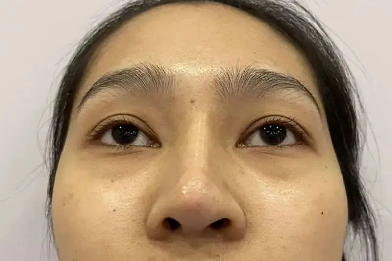 Mũi bị lệch sụn do kỹ thuật đặt sụn sai của bác sĩ