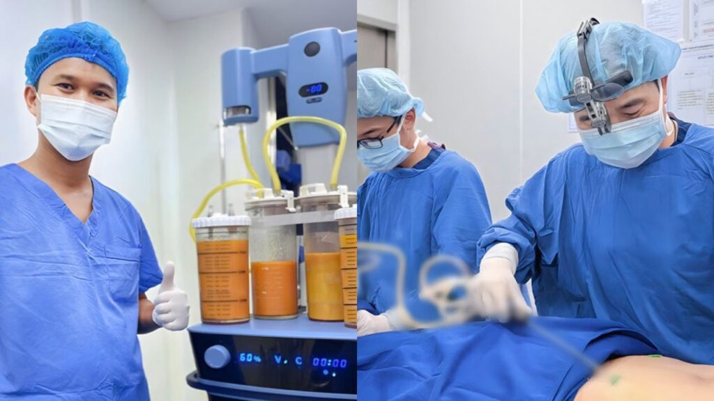 Lipo tia sương giá bao nhiêu, tính trọn gói hay tính theo từng vùng?