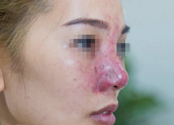 Đầu mũi bóng đỏ sau nâng có thể liên quan đến nhiều nguyên nhân và cần được bác sĩ kiểm tra để xác định tình trạng cụ thể.