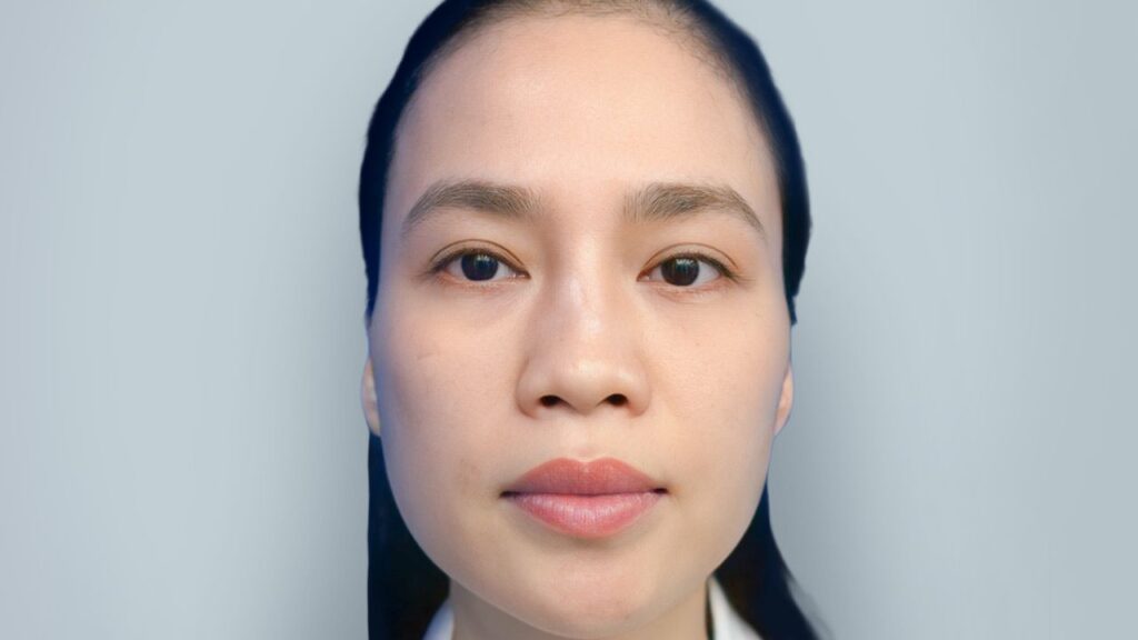 Mũi bị lộ sóng thấy rõ đường viền sụn thì khắc phục thế nào?