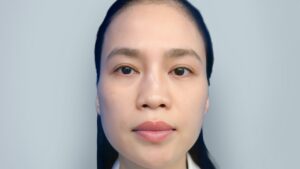 Mũi bị lộ sóng thấy rõ đường viền sụn thì khắc phục thế nào?