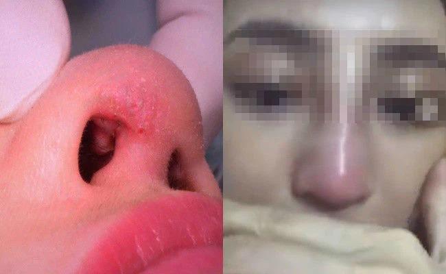 Sưng đỏ rõ, đau tăng, chảy dịch hoặc các bất thường kéo dài ở vùng mũi có thể là dấu hiệu cần được bác sĩ kiểm tra sớm.