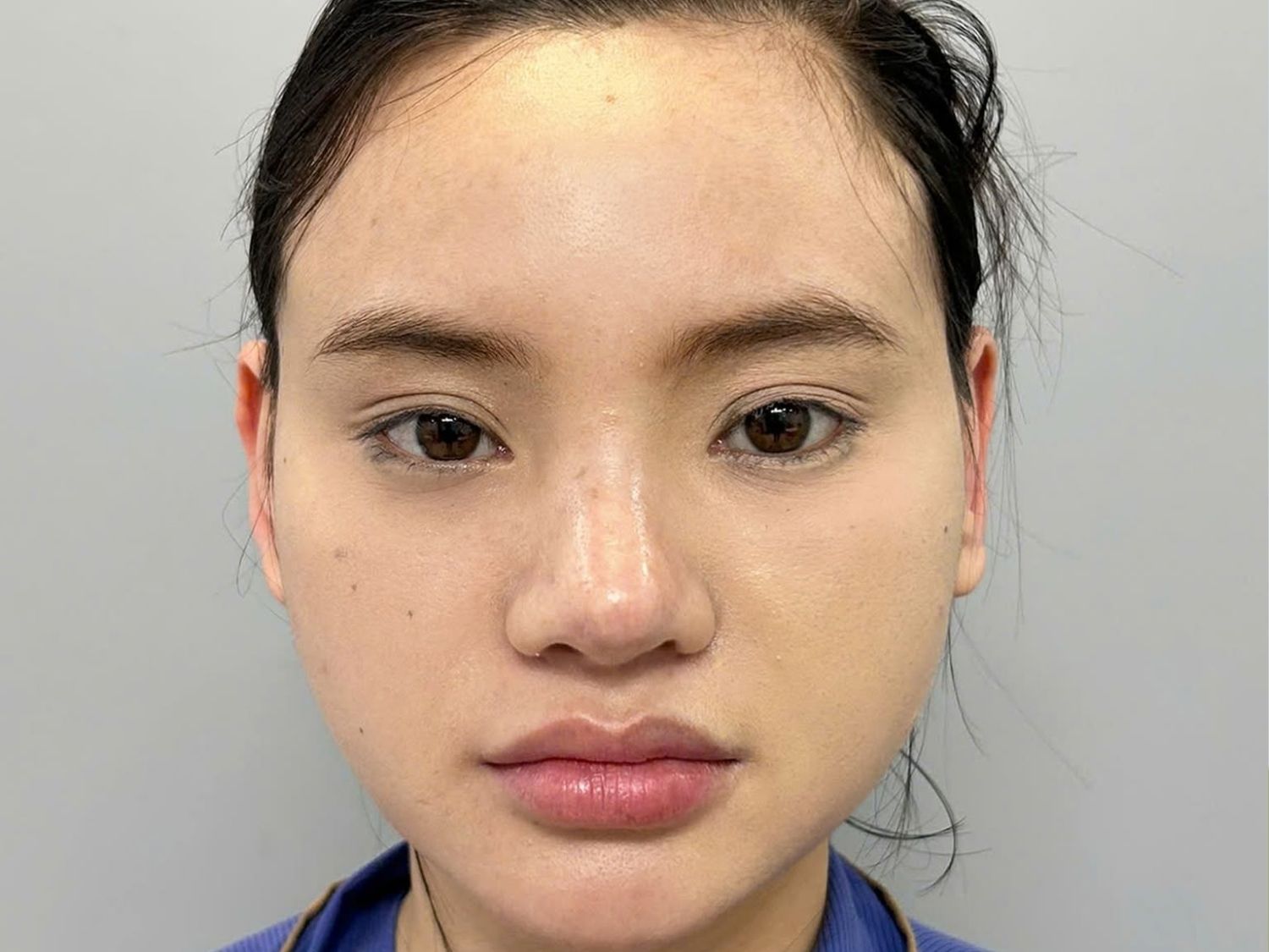 Tình trạng mũi lệch sang 1 bên